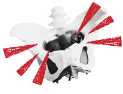 a skeleton pelvis with ouchy red lines coming out of it